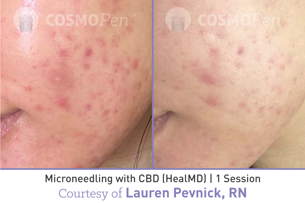 treatment with cosmopen and healmd