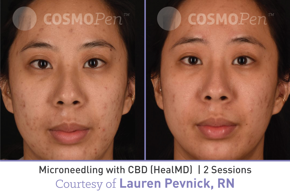 treatment with cosmopen and healmd